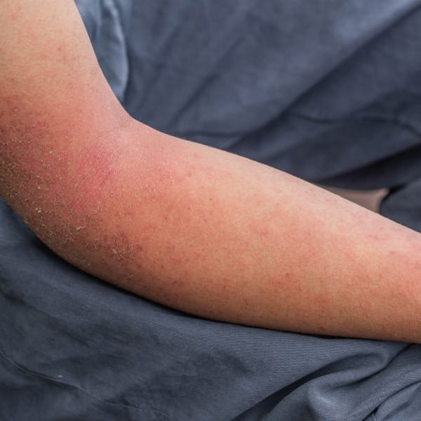 Autoimmune-Disease